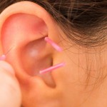 auricular-ear-acupuncture